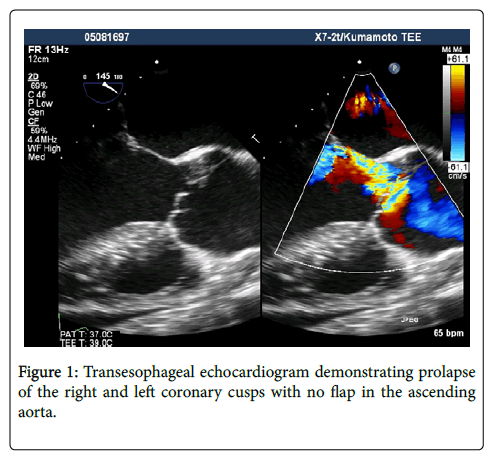 clinical-experimental-cardiology-Transesophageal-echocardiogram