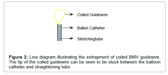 clinical-experimental-cardiology-straightening-tube