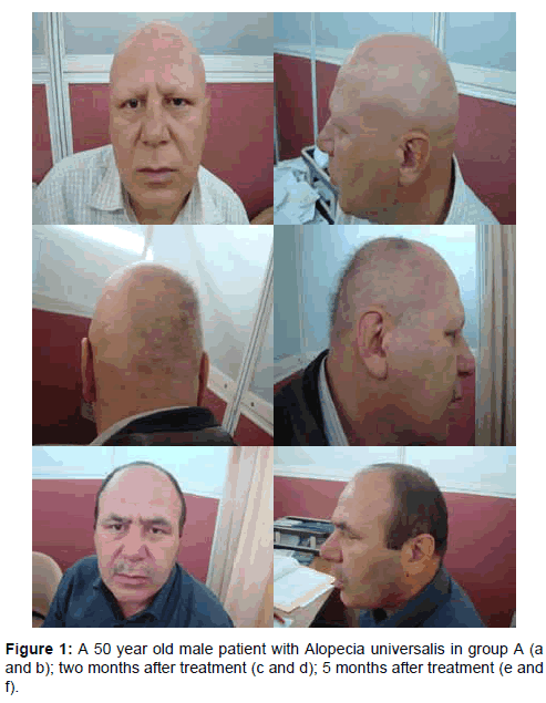 clinical-experimental-dermatology-Alopecia-universalis