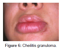 clinical-experimental-dermatology-Cheilitis-granuloma
