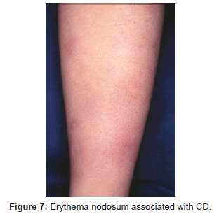 clinical-experimental-dermatology-Erythema-nodosum
