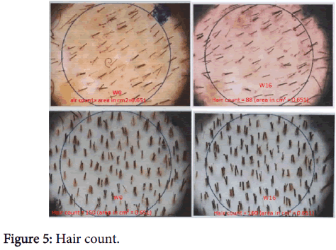 clinical-experimental-dermatology-Hair-count