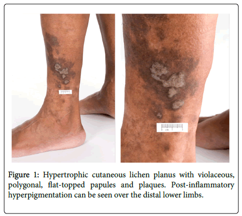 clinical-experimental-dermatology-Hypertrophic-cutaneous