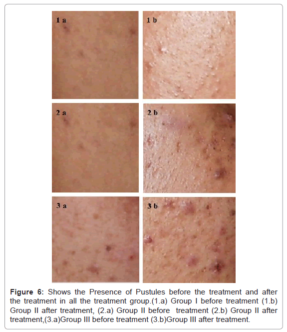 clinical-experimental-dermatology-Pustules-before