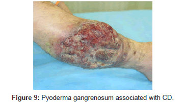 clinical-experimental-dermatology-Pyoderma-gangrenosum