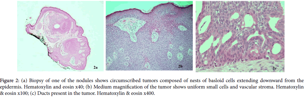 clinical-experimental-dermatology-circumscribed-tumors