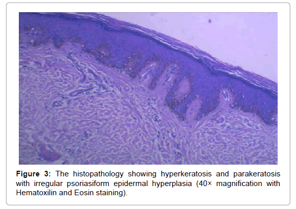 clinical-experimental-dermatology-research-histopathology-showing