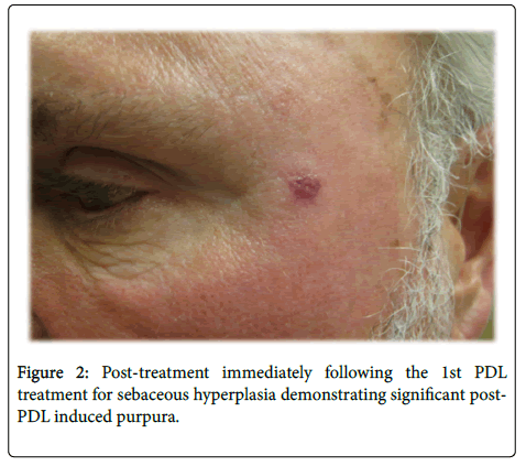 clinical-experimental-dermatology-research-post-treatment-papule