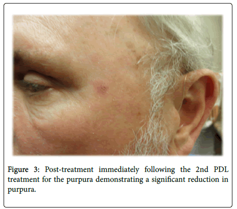 clinical-experimental-dermatology-research-reduction-in-purpura