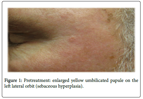 clinical-experimental-dermatology-research-umbilicated-papule