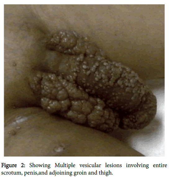 clinical-experimental-dermatology-vesicular-lesions