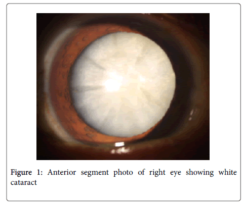 clinical-experimental-ophthalmology-Anterior-segment