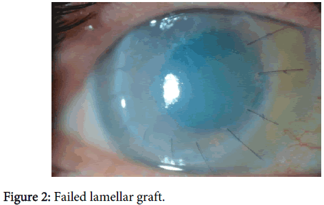 clinical-experimental-ophthalmology-Failed-lamellar