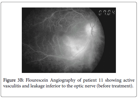 clinical-experimental-ophthalmology-Flourescein-Angiography