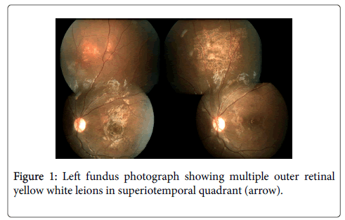 clinical-experimental-ophthalmology-Left-fundus
