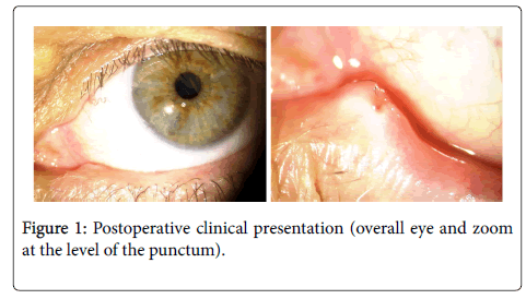clinical-experimental-ophthalmology-Postoperative-clinical