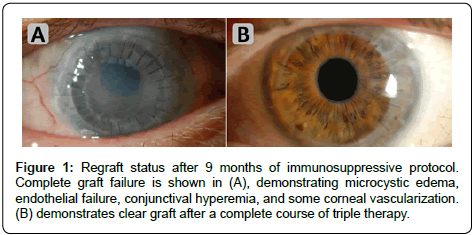 clinical-experimental-ophthalmology-Regraft-status