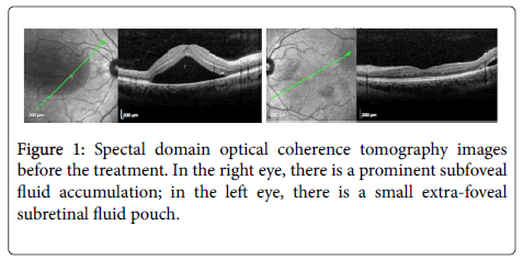 clinical-experimental-ophthalmology-Spectal-domain