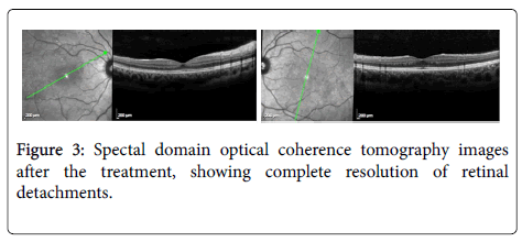 clinical-experimental-ophthalmology-Spectal-domain