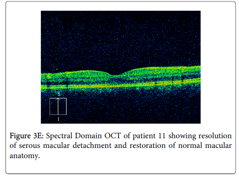 clinical-experimental-ophthalmology-Spectral-Domain