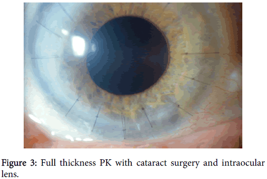 clinical-experimental-ophthalmology-cataract-surgery