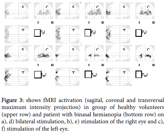 clinical-experimental-ophthalmology-fMRI-activation