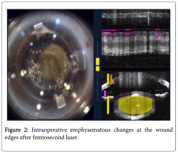 clinical-experimental-ophthalmology-femtosecond-laser