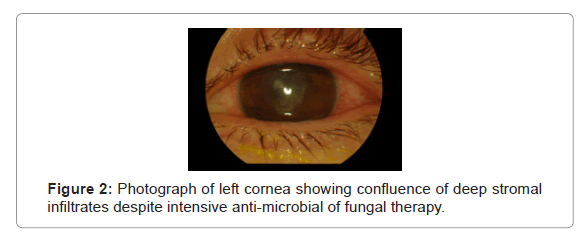 clinical-experimental-ophthalmology-fungal-therapy