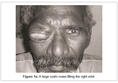 clinical-experimental-ophthalmology-large-cystic
