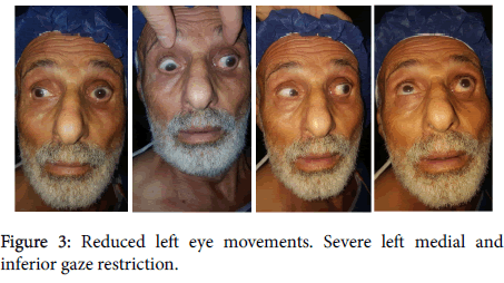clinical-experimental-ophthalmology-left-eye