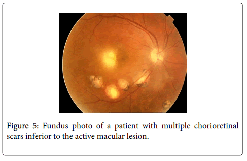 clinical-experimental-ophthalmology-multiple-chorioretinal