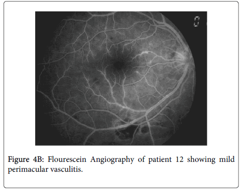 clinical-experimental-ophthalmology-perimacular-vasculitis