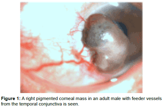 clinical-experimental-ophthalmology-pigmented-corneal