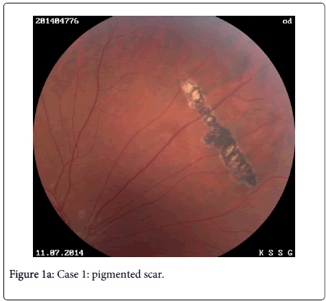clinical-experimental-ophthalmology-pigmented-scar