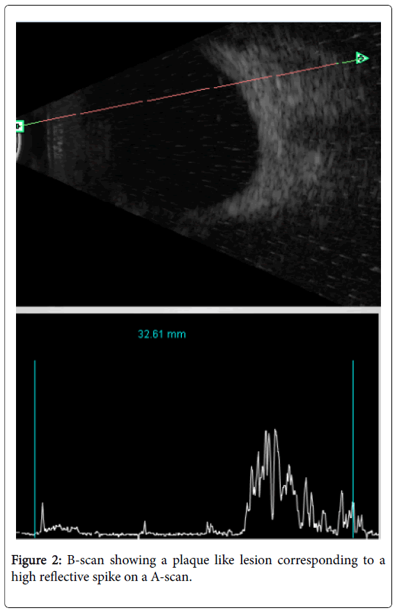 clinical-experimental-ophthalmology-spike-A-scan