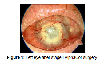 clinical-ophthalmology-Left-eye