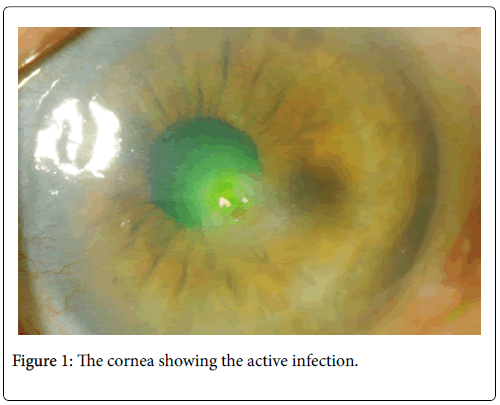 clinical-ophthalmology-active-infection