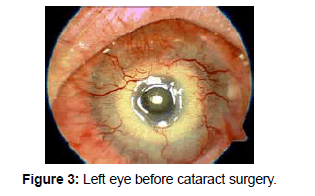 clinical-ophthalmology-cataract-surgery