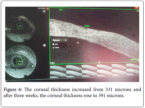 clinical-ophthalmology-corneal-thickness