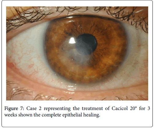 clinical-ophthalmology-epithelial-healing