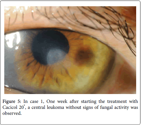 clinical-ophthalmology-fungal-activity