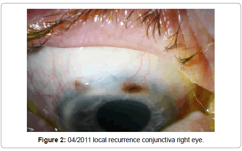 clinical-ophthalmology-local-recurrence