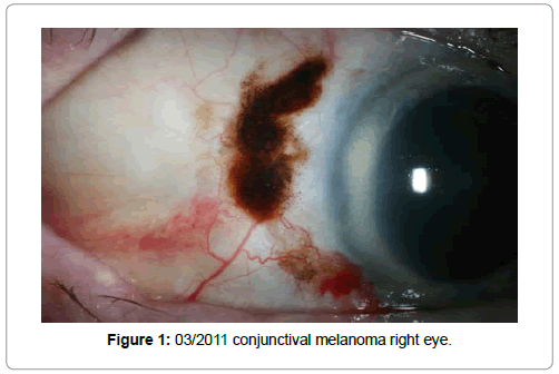 clinical-ophthalmology-melanoma-right