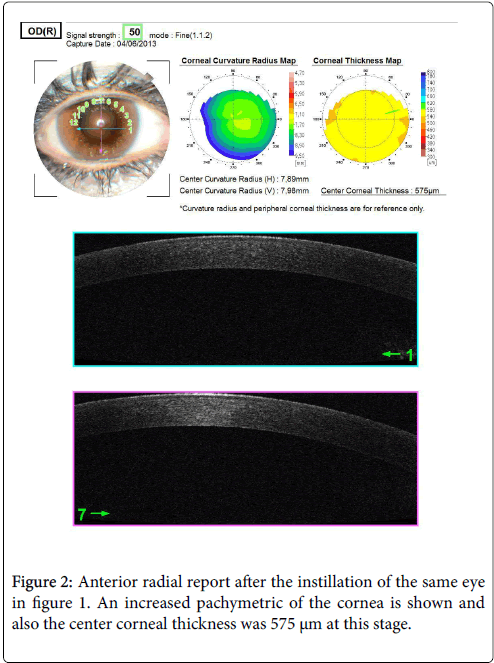 clinical-ophthalmology-pachymetric-cornea