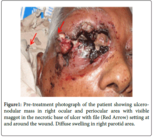 Orbital Myiasis (Dermatobia Hominis)Complicating Secondary Squamo