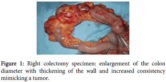 clinical-toxicology-Right-colectomy