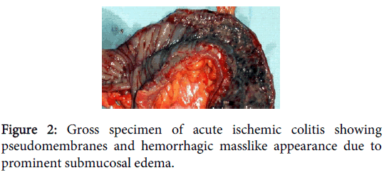 clinical-toxicology-ischemic-colitis