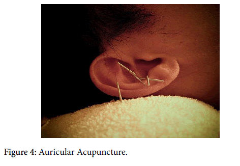 clinical-trials-Auricular-Acupuncture