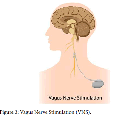 clinical-trials-Brick-Vagus-Nerve-Stimulation