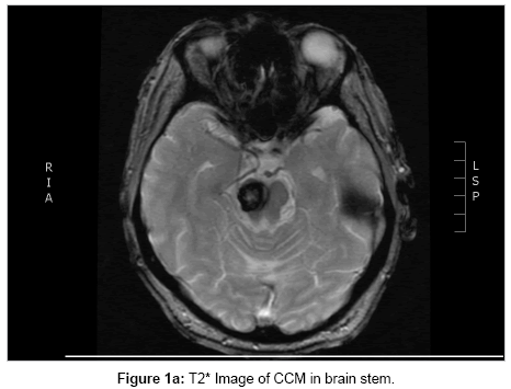 clinical-trials-CCM-brain-stem